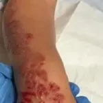 Allergia all’hennè: bambina di 7 anni ustionata dal tatuaggio