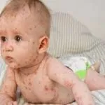 Varicella a 3 anni, morto per una infezione rarissima da Streptococco A
