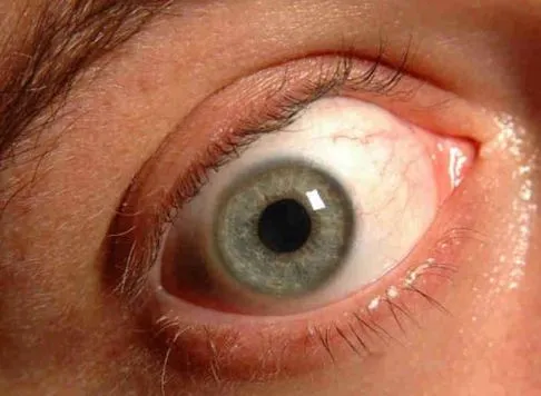 Glaucoma, malattia fulminante della vista: si può prevenire?