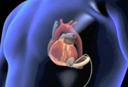 Niguarda, primo trapianto di cuore artificiale effettuato in Italia con telemonitoraggio