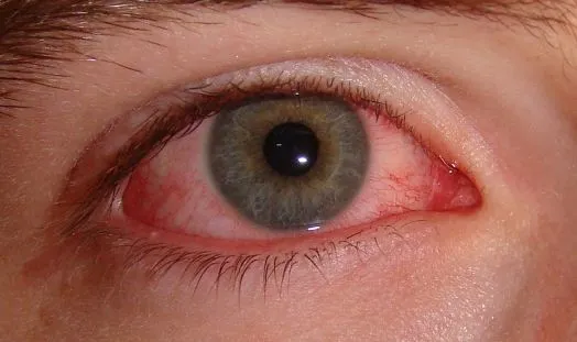 Sindrome occhio secco: se preso in tempo migliora la vita