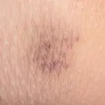 Come nascondere un livido?