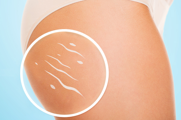 Come eliminare la cellulite, i rimedi più efficaci