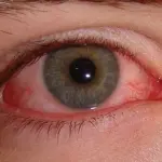 Sindrome occhio secco: come va curata?