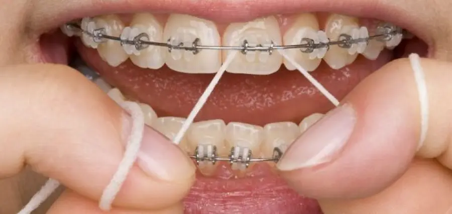 Denti: quando mettere l'apparecchio