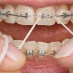 Denti: quando mettere l'apparecchio