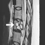 Scoperta shock, formicolio alle gambe scopre una tenia di cane nella schiena