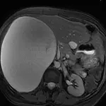 Intervento record, asportato un tumore da 20 centimetri