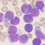 Leucemia infantile cause: troppa igiene favorisce la malattia