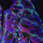 Test del sangue per diagnosi tumore alla prostata: ecco come funziona