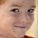 Varicella party a Milano: ecco chi è la mamma no vax