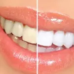 Denti bianchi rovinati da diete e alcol, perché?