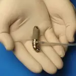 Bambino Gesù di Roma, mini-cuore artificiale salva una bambina