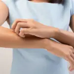 Nuova cura per la psoriasi, test su 1700 pazienti