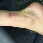 Ulcera carnivora in Australia, i medici lanciano l'allarme