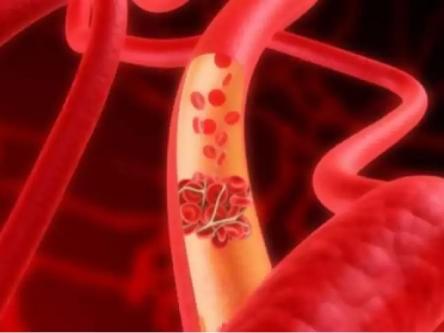 Trombosi: giornata nazionale per la lotta all'embolia, ma quanto si conosce davvero?