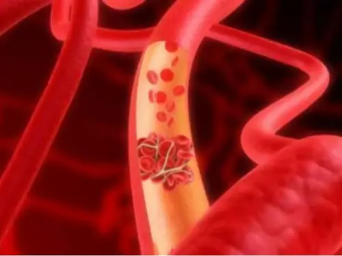 Trombosi: giornata nazionale per la lotta all'embolia, ma quanto si conosce davvero?