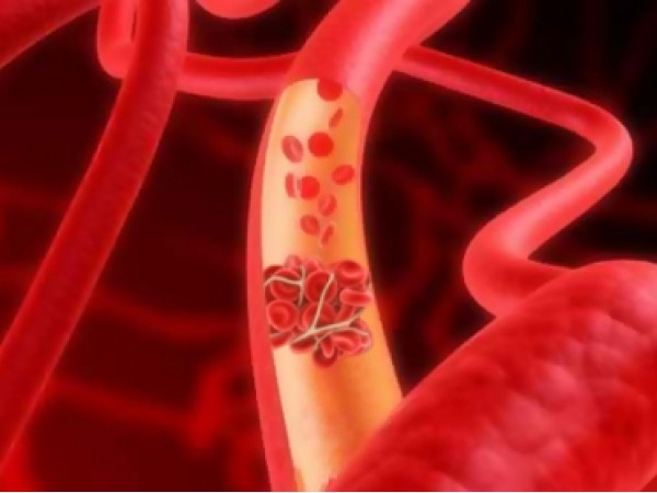 Trombosi: giornata nazionale per la lotta all'embolia, ma quanto si conosce davvero?