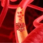 Trombosi: giornata nazionale per la lotta all'embolia, ma quanto si conosce davvero?