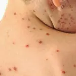 Nuovo caso di morbillo a Catania, morto un bambino
