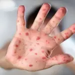 Morbillo contagio, morta a Catania una donna di 25 anni