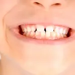 Carie: perché peggiora il rendimento scolastico dei bambini?