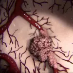 Amianto e tumori, Taranto percentuale da record