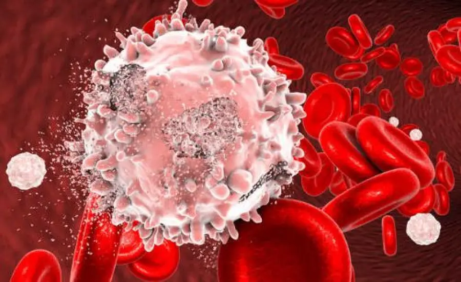 Leucemia, messo in atto un test che avverte se c'è il rischio ricadute