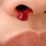 Parassita, estratto dal naso di una donna un essere sconosciuto in Europa