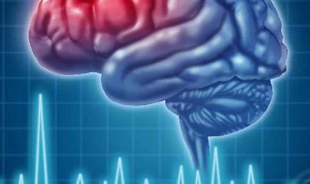 Ictus e il nuovo miracolo della scienza per combatterlo: arriva "l'iniziativa dell'angelo"