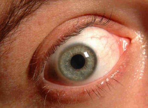 Glaucoma, malattia fulminante della vista: si può prevenire?