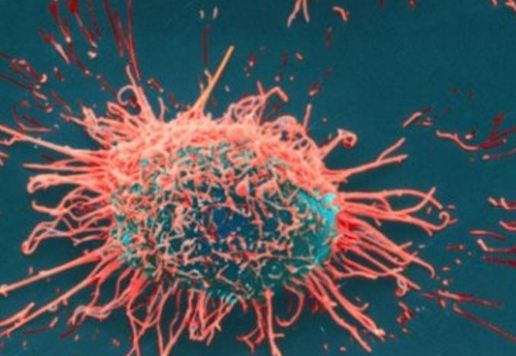 Tumore alla prostata: scoperto enzima che blocca lo sviluppo delle metastasi