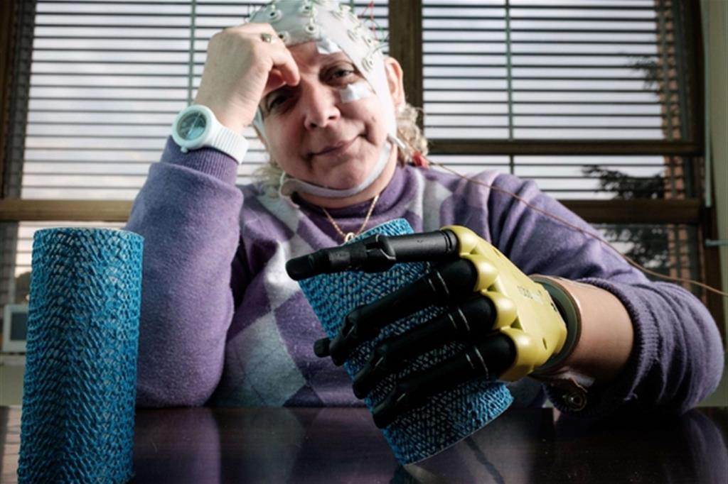 Prima mano bionica impiantata in Italia