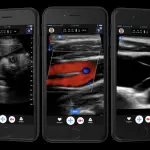 Butterfly IQ, dal 2018 ecografie si fanno direttamente con lo smartphone