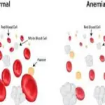 Svolta cura anemia mediterranea: chirurgia chimica su DNA elimina talassemia