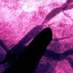 Scoperto antinfiammatorio a base di canakinumab che riduce il rischio infarto e ictus