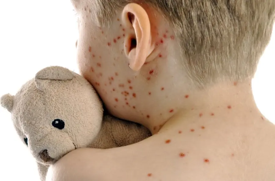 Morbillo, scatta l'allarme: registrati in Italia, 400 casi a giugno