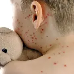 Morbillo, scatta l'allarme: registrati in Italia, 400 casi a giugno