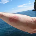 Allarme meduse, consigli in caso di puntura