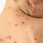 Vaccini,muore un bambino di 6 anni per morbillo