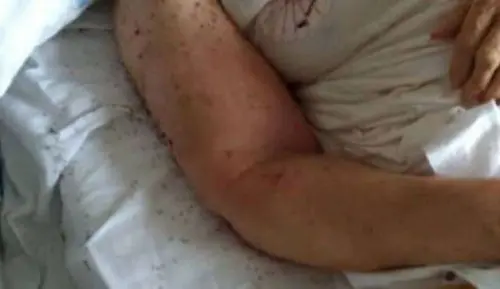 Formiche all'ospedale di Napoli, è shock