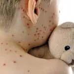 Epidemia morbillo, casi aumentati in Italia: le fasce a rischio contagio