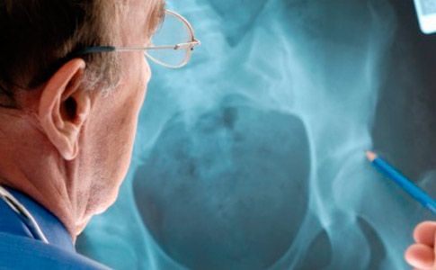 Osteoporosi, alti rischi anche per gli uomini: i consigli per una migliore prevenzione