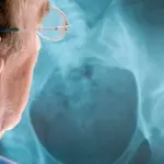 Osteoporosi, alti rischi anche per gli uomini: i consigli per una migliore prevenzione