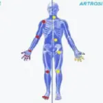 Artrite o artrosi, come riconoscerle? Differenze e cura adeguata