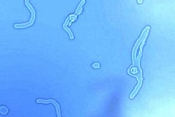 Mosche negli occhi, è possibile eliminarle? Intervento rivoluzionario