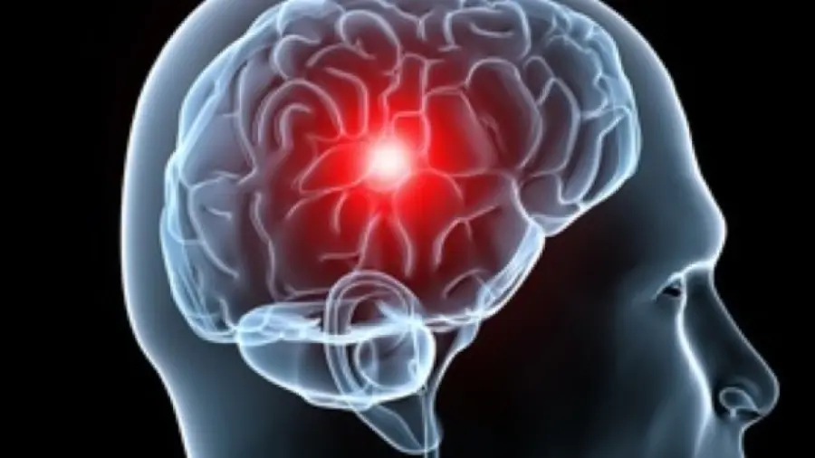 La causa dell'Ictus è un enzima killer: arriva la scoperta, info dettagli