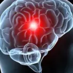 La causa dell'Ictus è un enzima killer: arriva la scoperta, info dettagli