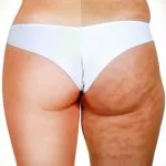 Cellulite, come eliminarla con i rimedi naturali e la dieta