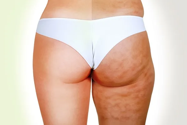 Cellulite, come eliminarla con i rimedi naturali e la dieta